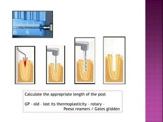 Calculate the appropriate length of the post
GP – old – lost its thermoplasticity – rotary –
Peeso reamers / Gates glidden
 
