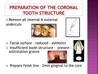  Remove all internal & external
undercuts
 Facial surface – reduced - esthetics
 Insufficient tooth structure - present –
antirotation groove
 Prepare finish line – 2mm gingival to the core
 