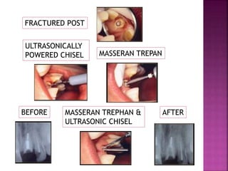 FRACTURED POST
ULTRASONICALLY
POWERED CHISEL MASSERAN TREPAN
BEFORE MASSERAN TREPHAN &
ULTRASONIC CHISEL
AFTER
 