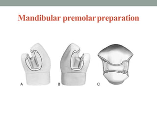Mandibular premolarpreparation
 