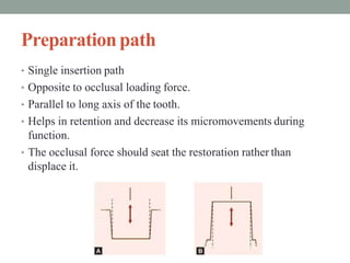 Preparationpath
• Single insertion path
• Opposite to occlusal loading force.
• Parallel to long axis of the tooth.
• Helps in retention and decrease its micromovements during
function.
• The occlusal force should seat the restoration rather than
displace it.
 