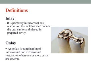 Definitions
Inlay
- It is primarily intracoronal cast
restoration that is fabricated outside
the oral cavity and placed in
prepared cavity.
Onlay
- An onlay is combination of
intracoronal and extracoronal
restoration when one or more cusps
are covered.
 