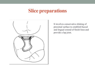 Slice preparations
It involves conservative disking of
proximal surface to establish buccal
and lingual extend of finish lines and
provide a lap joint.
 