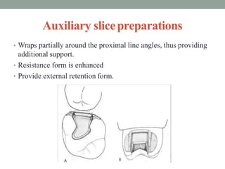 Auxiliary slicepreparations
• Wraps partially around the proximal line angles, thus providing
additional support.
• Resistance form is enhanced
• Provide external retention form.
 