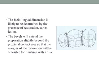 • The facio-lingual dimension is
likely to be determined by the
presence of restoration, caries
lesion.
• The bevels will extend the
preparation slightly beyond the
proximal contact area so that the
margins of the restoration will be
accesible for finishing with a disk.
 