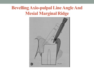 BevellingAxio-pulpal LineAngleAnd
Mesial MarginalRidge
 