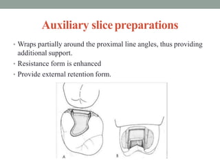Auxiliary slicepreparations
• Wraps partially around the proximal line angles, thus providing
additional support.
• Resist...