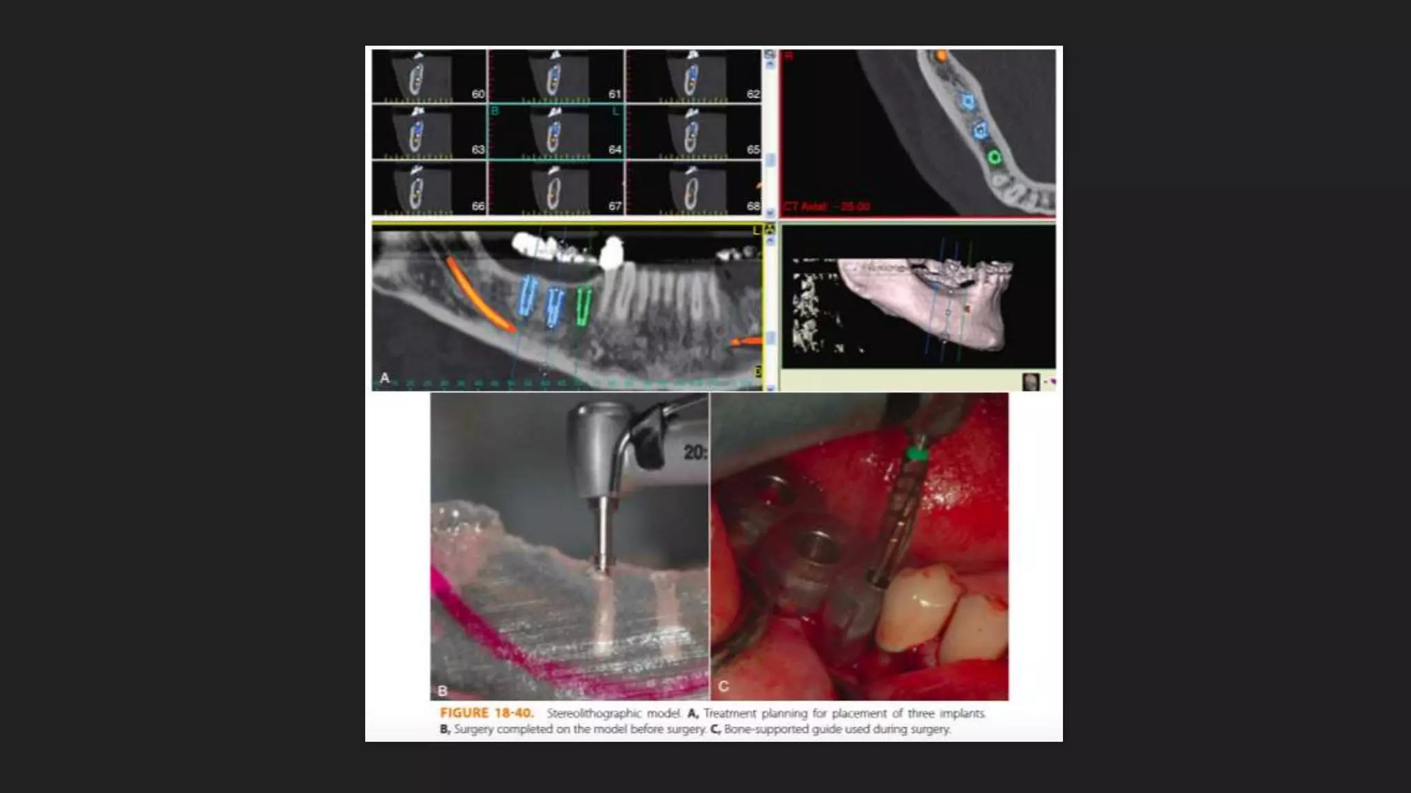 Diagnostic Casts,surgical templates and provisionalization | PPTX