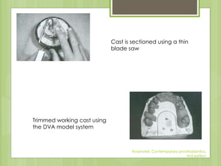 Cast is sectioned using a thin
blade saw
Trimmed working cast using
the DVA model system
Rosensteil, Contemporary prosthod...