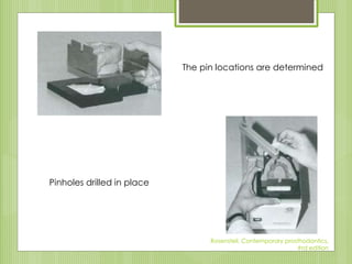 The pin locations are determined
Pinholes drilled in place
Rosensteil, Contemporary prosthodontics,
#rd edition
 
