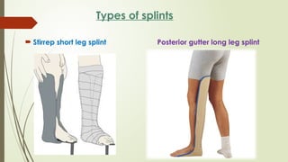 CAST,SPLINTS,TRACTION.pptx By Sanjay Acharya | PPTX