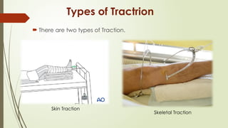 CAST,SPLINTS,TRACTION.pptx By Sanjay Acharya | PPTX