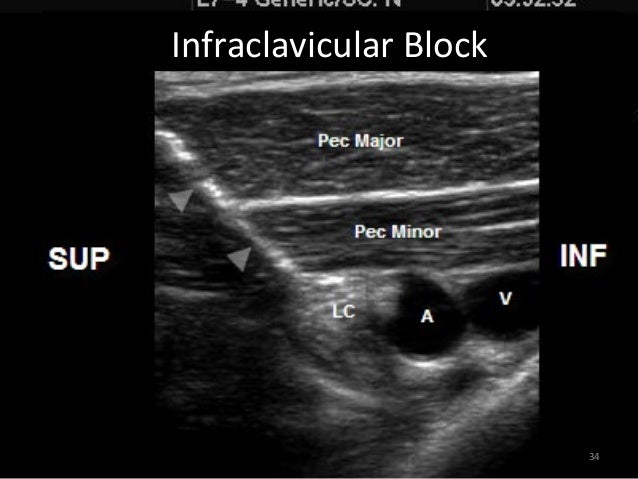 pec block