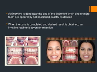 Refinement Teeth Some of these treatment option includes ceramic brackets, Essix ...