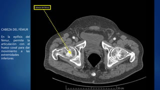 CABEZA DEL FÉMUR
En la epífisis del
fémur, permite la
articulación con el
hueso coxal para dar
movimiento a las
extremidades
inferiores