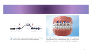 clear aligner in orthodontics a complete guid.pptx