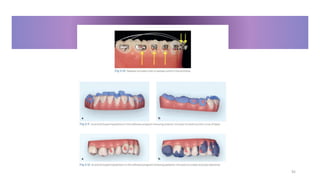clear aligner in orthodontics a complete guid.pptx