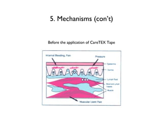5. Mechanisms (con’t) Before the application of CareTEX Tape 