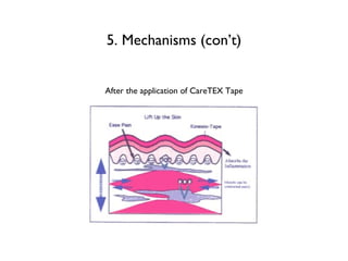 5. Mechanisms (con’t) After the application of CareTEX Tape 