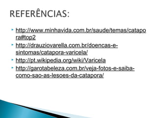  http://www.minhavida.com.br/saude/temas/catapo
  ra#top2
 http://drauziovarella.com.br/doencas-e-

  sintomas/catapora-varicela/
 http://pt.wikipedia.org/wiki/Varicela
 http://garotabeleza.com.br/veja-fotos-e-saiba-

  como-sao-as-lesoes-da-catapora/
 