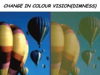 CHANGE IN COLOUR VISION(DIMNESS) 