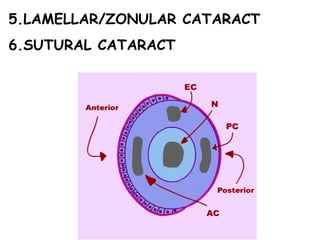 5.LAMELLAR/ZONULAR CATARACT 6.SUTURAL CATARACT 