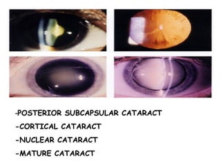 - POSTERIOR SUBCAPSULAR CATARACT -CORTICAL CATARACT -NUCLEAR CATARACT -MATURE CATARACT 