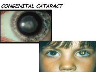 CONGENITAL CATARACT 