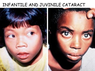 INFANTILE AND JUVINILE CATARACT 