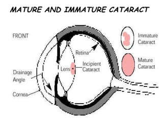 MATURE AND IMMATURE CATARACT 