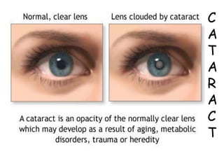 CATARACT 