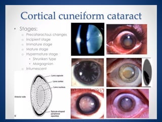 Comprehensive Overview of Cataract: Types, Causes, and Treatments | PPTX