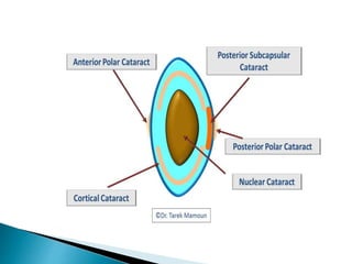 Cataract Structure Cataract | PPTX