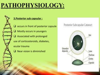 3.Posterior sub capsular :
 occurs in front of posterior capsule
 Mostly occurs in youngers
 Associated with prolonged
use of corticosteroids, diabetes,
ocular trauma
 Near vision is diminished
PATHOPHYSIOLOGY:
 