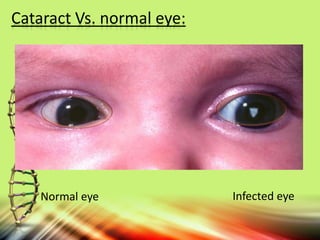 Normal eye Infected eye
Cataract Vs. normal eye:
 