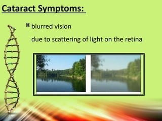 Cataract Symptoms:
blurred vision
due to scattering of light on the retina
 