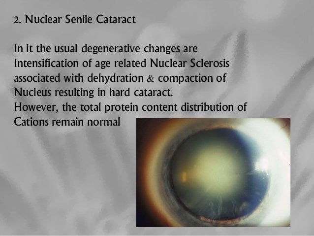 Cataract