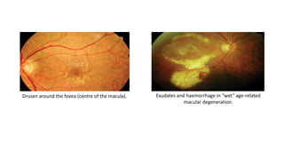 Drusen around the fovea (centre of the macula). Exudates and haemorrhage in “wet” age-related
macular degeneration.
 