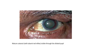 Mature cataract (with absent red reflex) visible through the dilated pupil
 