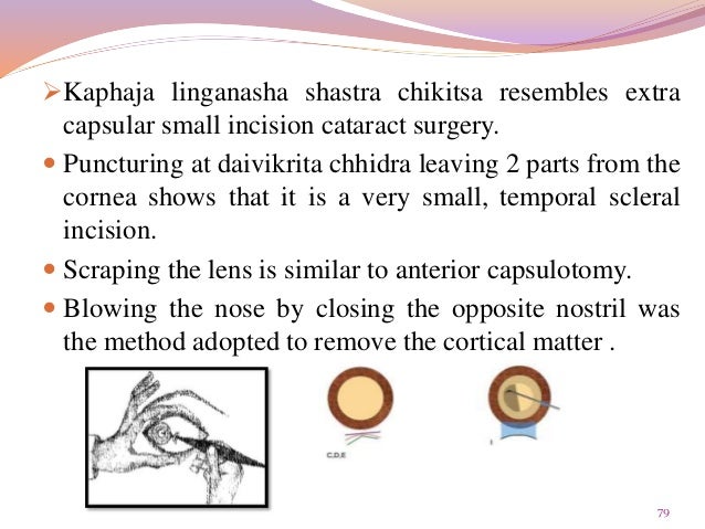 Timira With Special Reference To Cataract And Its Prevention - 