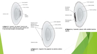 Cataract | PPTX