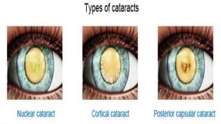 Cataract | PPTX