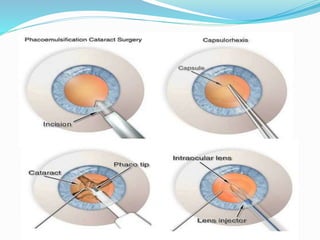 Cataract | PPTX
