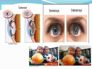 Cataract | PPTX