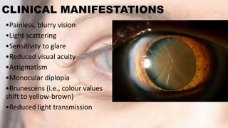 Cataract and its management | PPTX