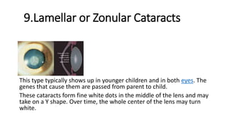 Cataract | PPTX