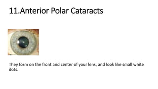 Cataract | PPTX