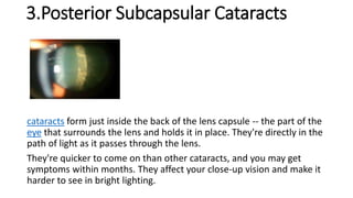 Cataract | PPTX