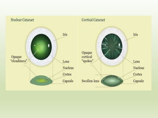 Cataract Structure Cataract | PPTX