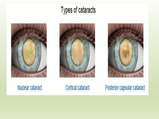 Cataract | PPTX